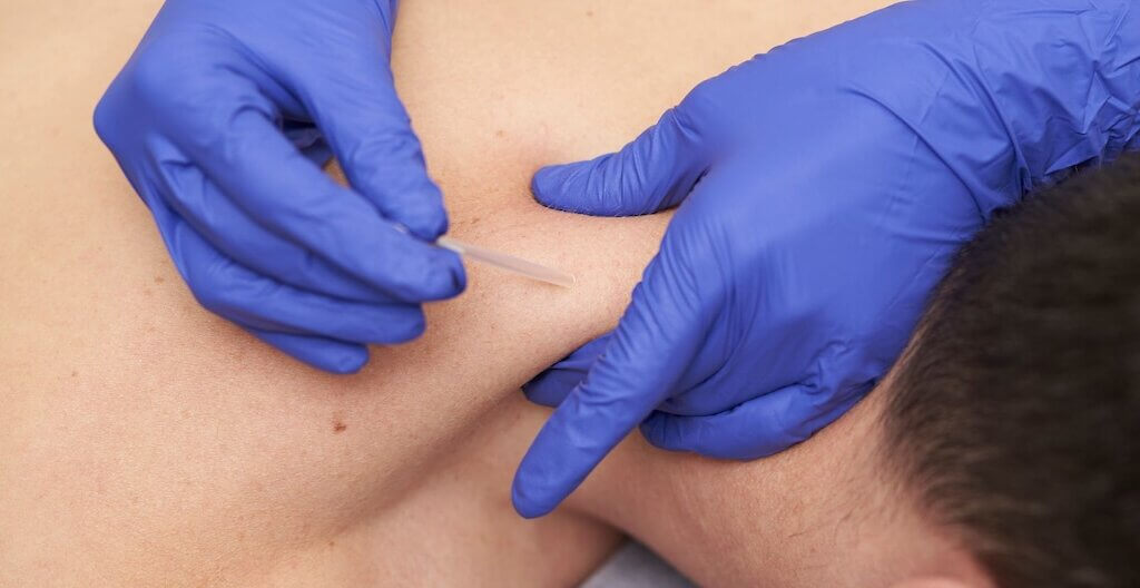 Was PhysiotherapeutInnen über die intramuskuläre Triggerpunkttherapie wissen sollten.