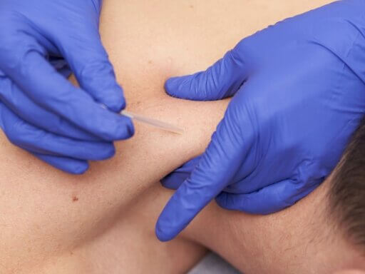 Was PhysiotherapeutInnen über die intramuskuläre Triggerpunkttherapie wissen sollten.