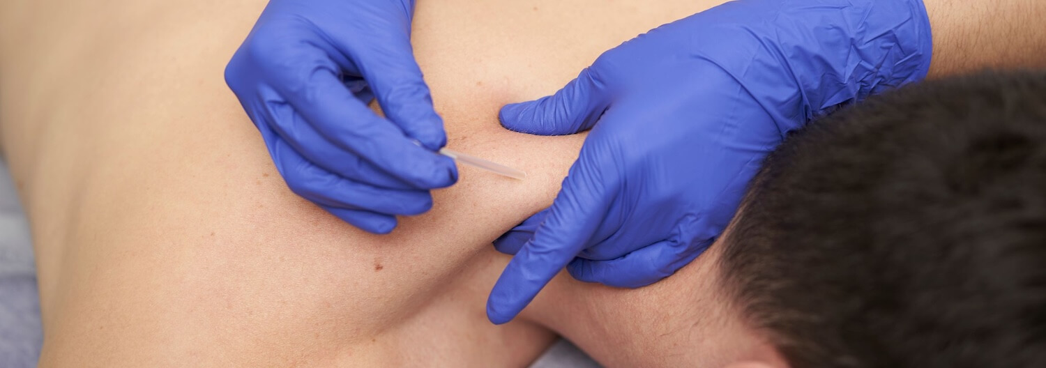 Was PhysiotherapeutInnen über die intramuskuläre Triggerpunkttherapie wissen sollten.